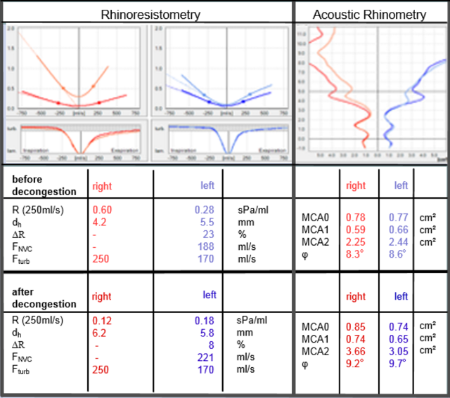 Befund mit RHINO-SYS durch Rhinoresistometrie und akustische Rhinometrie